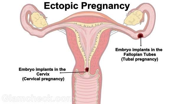 Laparoscopic Ectopic Pregnancy Management 