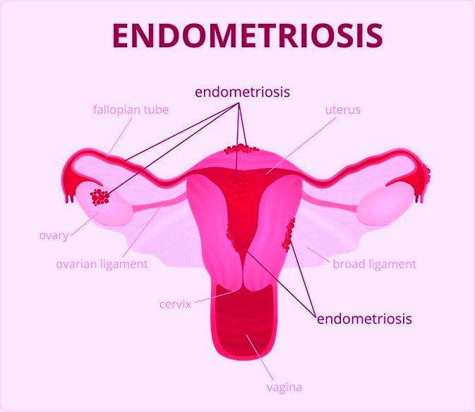 Laparoscopic Conservative Surgery For Endometriosis 5455