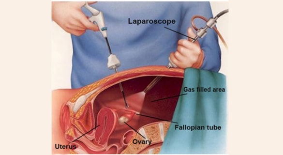 laparoscopic tubal ligation